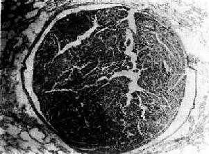 肺小动脉腔内肝癌细胞栓子