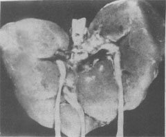 三体（Edwards）综合征的畸形肾