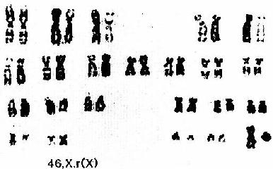 Turner综合征的一种核型 46,X,r(X)