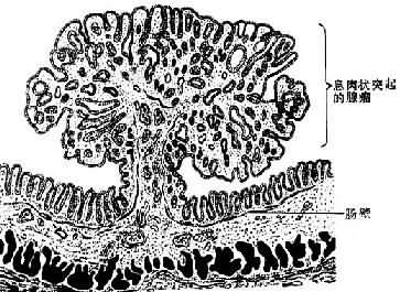 肠的息肉状腺瘤模式图