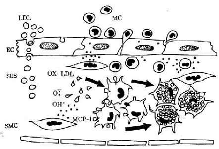 单核细胞迁入内膜及泡沫细胞形成模式图