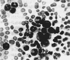 慢性粒细胞性白血病
