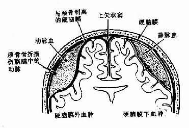 硬脑膜外血肿与硬脑膜下血肿示意图