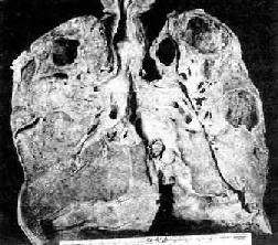 慢性纤维空洞型肺结核病（冠状切面）