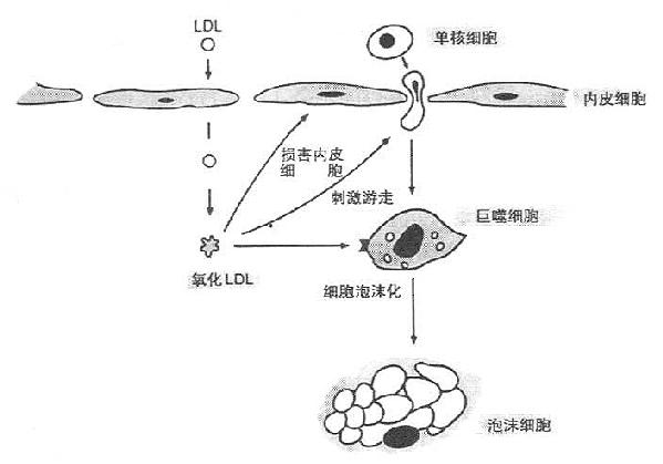 氧化LDL与动脉粥样硬化进展关系示意图