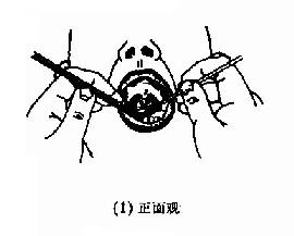 间接鼻咽镜（后鼻镜）检查法