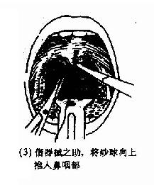 后鼻孔填塞法