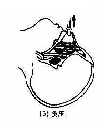 鼻窦置换法