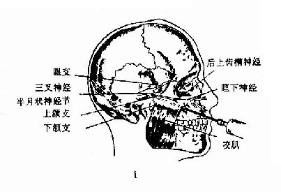 上颌窦根治术 1.麻醉