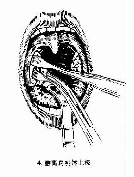 扁桃体切除术（剥离法）