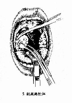 扁桃体切除术（剥离法）