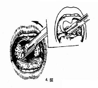 扁桃体挤切术