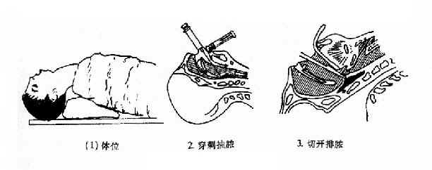 咽后脓肿切开引流