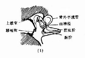 鼓室成形术