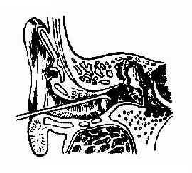 外耳道异物钩出法