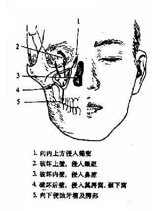 上颌窦癌的发展方向