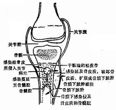 化脓性骨髓炎蔓延途径示意图