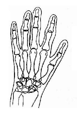 手及腕部类风湿性关节炎