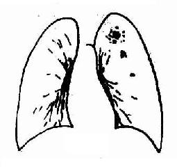 左上浸润型肺结核，锁骨上区浸润，软性病灶。