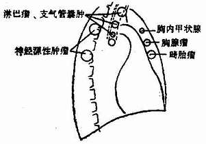 纵隔肿瘤发生部位