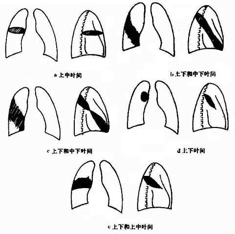 叶间积液的各种X线表现（正、侧位象）