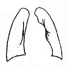 瓣膜型肺动脉狭窄