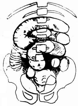 肠梗阻（仰卧位）胀气肠管呈层状排列