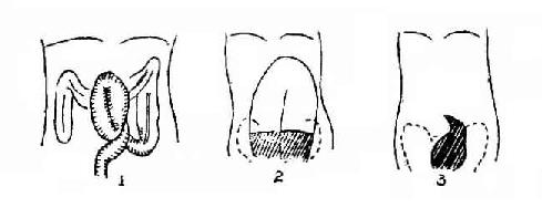 示直肠乙状结肠交接处梗阻、其上端逐渐变尖如鸟嘴状，有时可见到旋转的粘膜纹