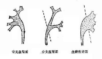 正常肾盂肾盏不同形状