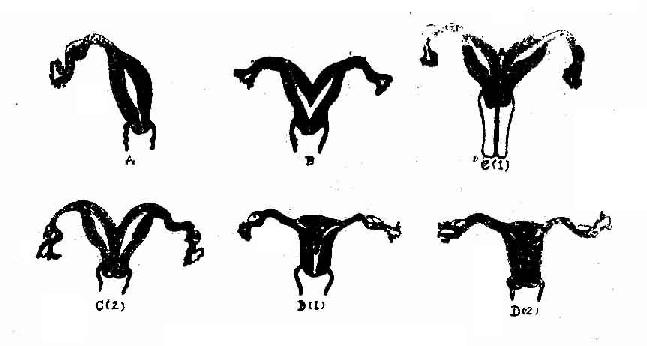 几种子宫先天性异常