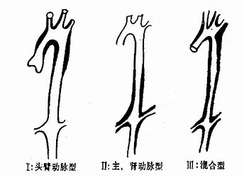 多发性大动脉炎分类示意图