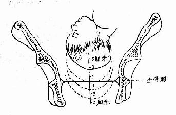 胎头高低的判定