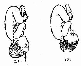 胎头俯曲