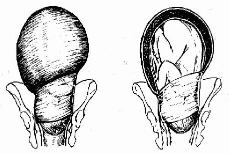 头盆不称引起的病理性缩复环
