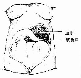 不完全性子宫破裂