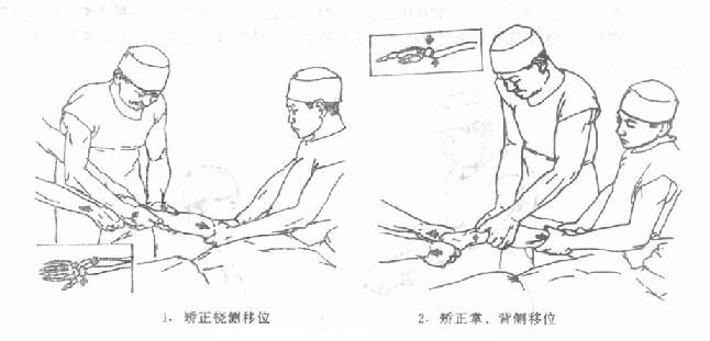 桡骨下端伸直型骨折复位情况