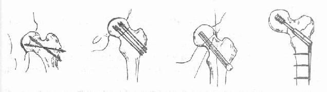 股骨颈骨折内固定方式