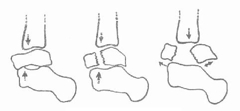 距骨颈及体部骨折及移位