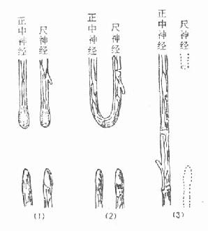 神经带蒂移植法