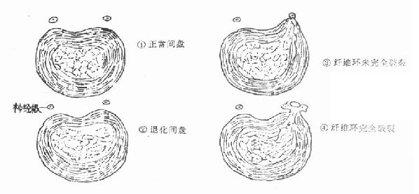 正常间盘及病理间盘