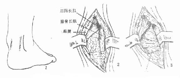 踝关节后外侧切开引流