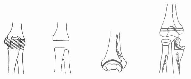 肘关节结核病灶清除和关节切除术