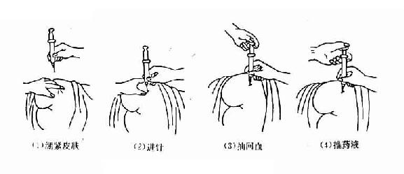 注射操作方法