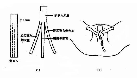 女病人留置导尿管固定法