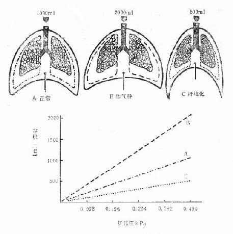不同肺顺应性的示意图