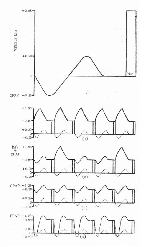 PEEP 治疗的各种机械通气类型