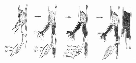 动脉栓塞远端电解质变化