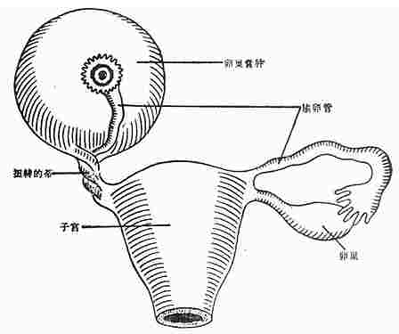 卵巢肿瘤扭转