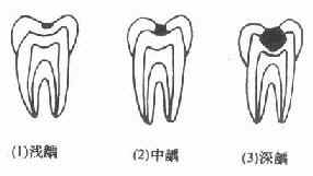 龋坏程度