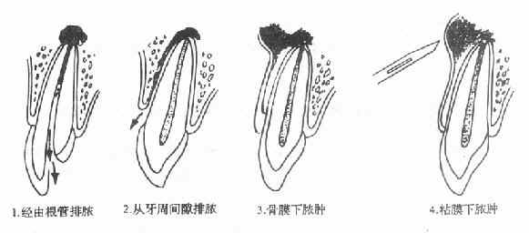 急性化脓性尖周炎排脓途径